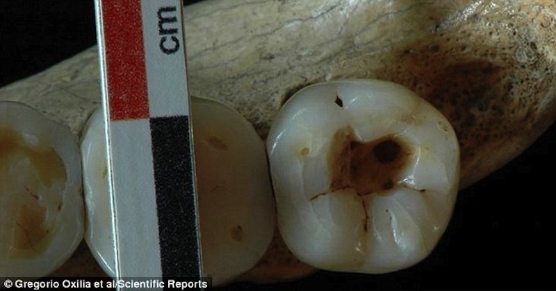 کشف اسکلت ۱۴هزار ساله با دندان ترمیم شده!