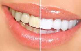 آیا خمیردندان سفیدکننده برای دندان ضرر دارد؟
