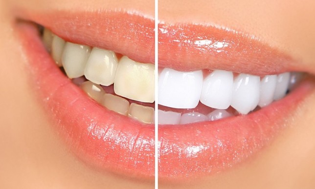آیا خمیردندان سفیدکننده برای دندان ضرر دارد؟
