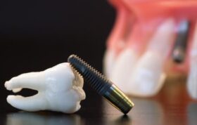 قیمت‌گذاری ایمپلنت‌های دندانی توسط وزارت بهداشت