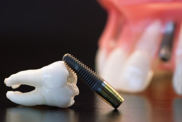 قیمت‌گذاری ایمپلنت‌های دندانی توسط وزارت بهداشت