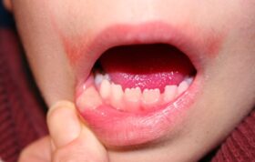 درباره زخم ناشی از جویدن لب و گونه کودکان بعد از دندانپزشکی