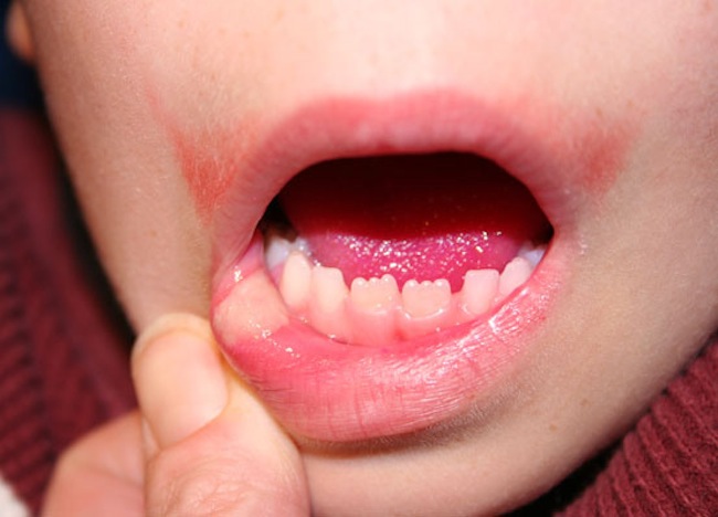 درباره زخم ناشی از جویدن لب و گونه کودکان بعد از دندانپزشکی