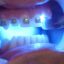 ماهیت نور آبی در دندانپزشکی چیست؟