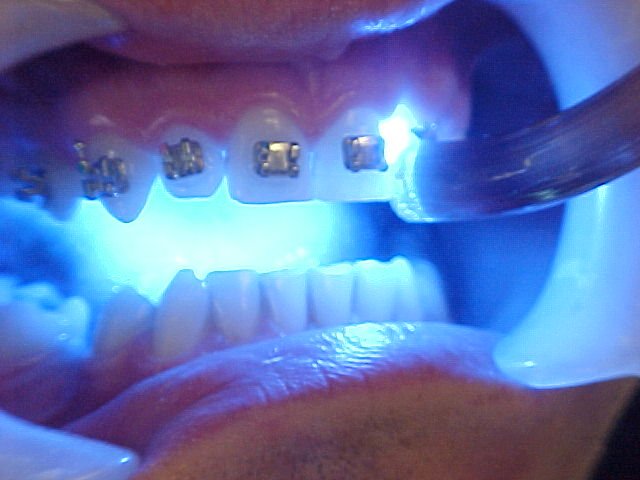 ماهیت نور آبی در دندانپزشکی چیست؟