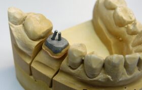 هسته تقویتی برای دندان/ مروری بر سیستم‌های پست و کور