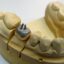 هسته تقویتی برای دندان/ مروری بر سیستم‌های پست و کور