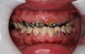 اگر پوسیدگی دندانی زیاد دارید دنداتان را با کامپوزیت‌ها پر نکنید