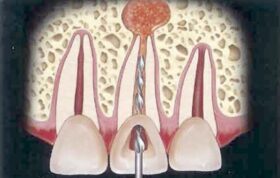 آیا درمان ریشه دندان مضر است؟