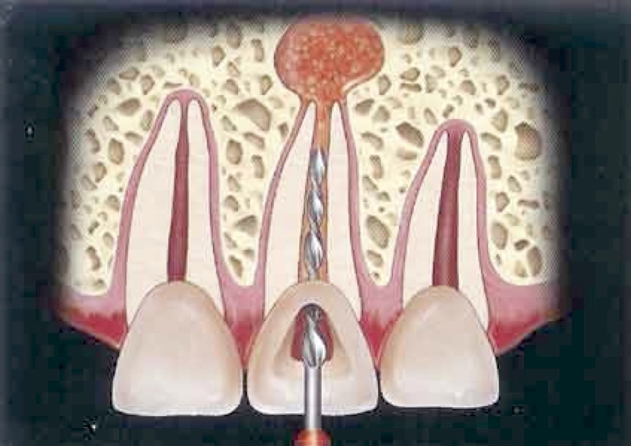 آیا درمان ریشه دندان مضر است؟
