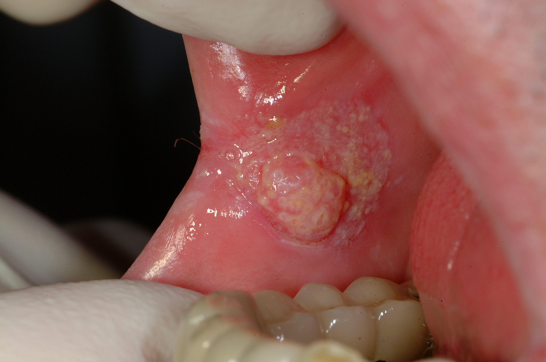 کدام بیماری‌ها از راه نشانه‌های دهانی شناسایی می‌شوند