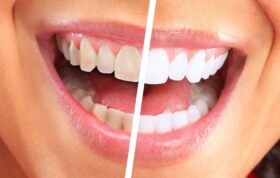 رنگ دندان سالم همیشه سفید نیست!