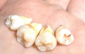 مراقبت‌های لازم پس از کشیدن دندان