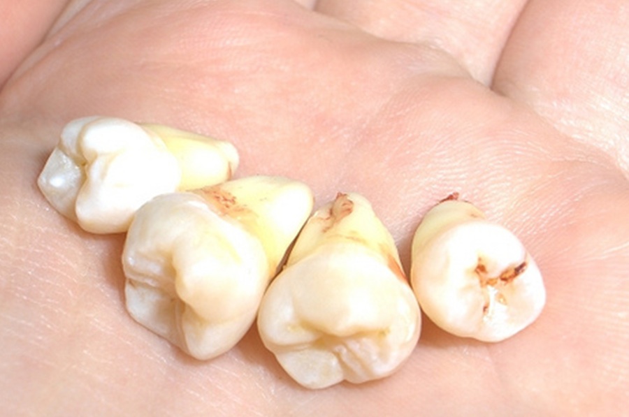 مراقبت‌های لازم پس از کشیدن دندان