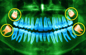 نکات جالبی که باید درباره دندان عقل بدانید!