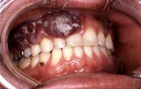بیماری ایدز در دهان چه اثری به‌جا می‌گذارد