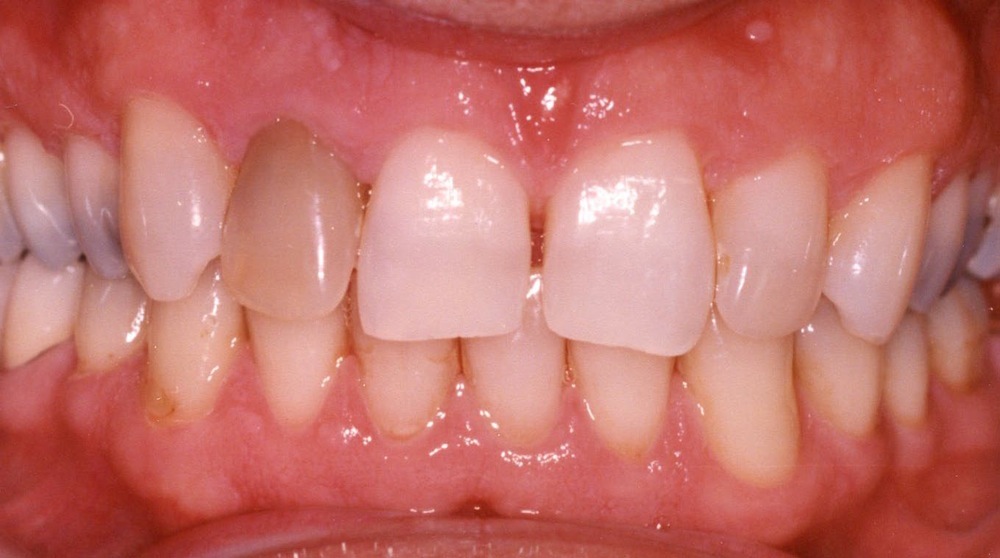 کدام داروها روی سلامت دندان‌ها اثر دارند؟