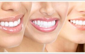 اصلاح نامرتبی دندان ها: یک بام و چند هوا! (قسمت اول)