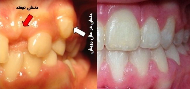 سرنوشت دندان‌های نهفته چیست؟