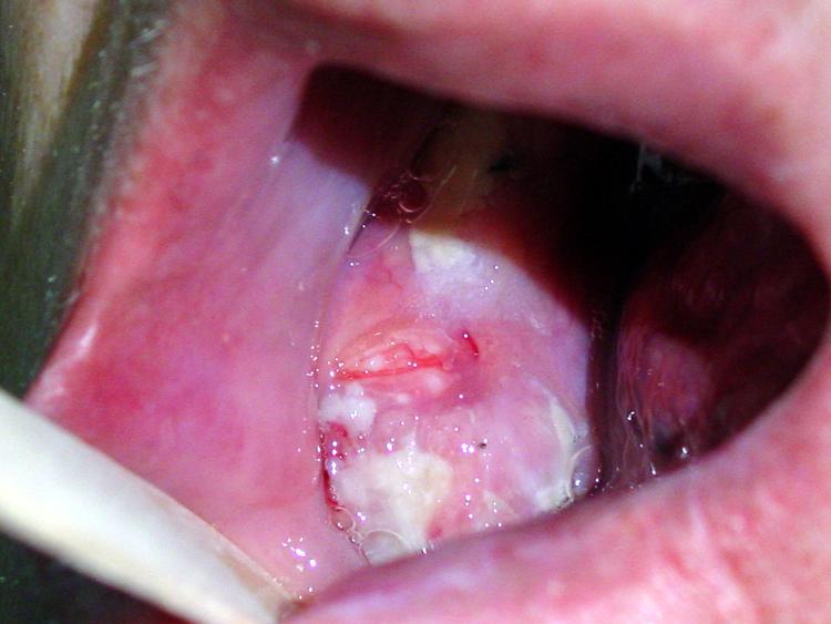 چه زخم‌هایی به سرطان دهان تبدیل می‌شوند؟