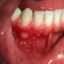 آیا بروز آفت بعد از مراجعه به دندانپزشک ناشی از آلودگی وسایل است؟