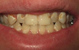 آیا رنگ دندان‌ها بعد از ارتودنسی زرد می‌شود؟