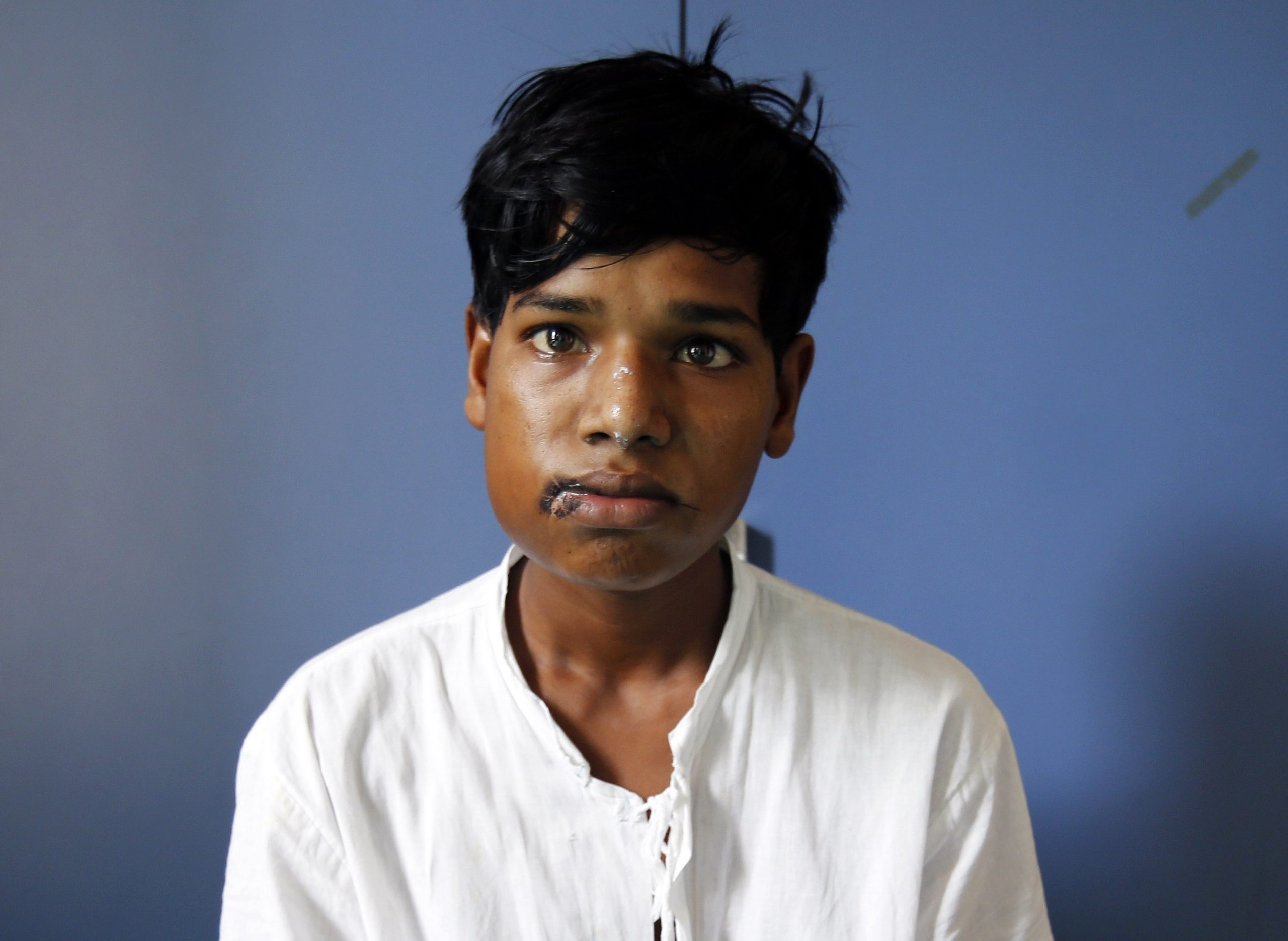 خارج کردن ۲۳۲ دندان از فک یک پسربچه هندی+ تحلیل خبر