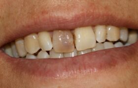 بلیچینگ داخلی (Internal Bleaching) دندان به زبان ساده