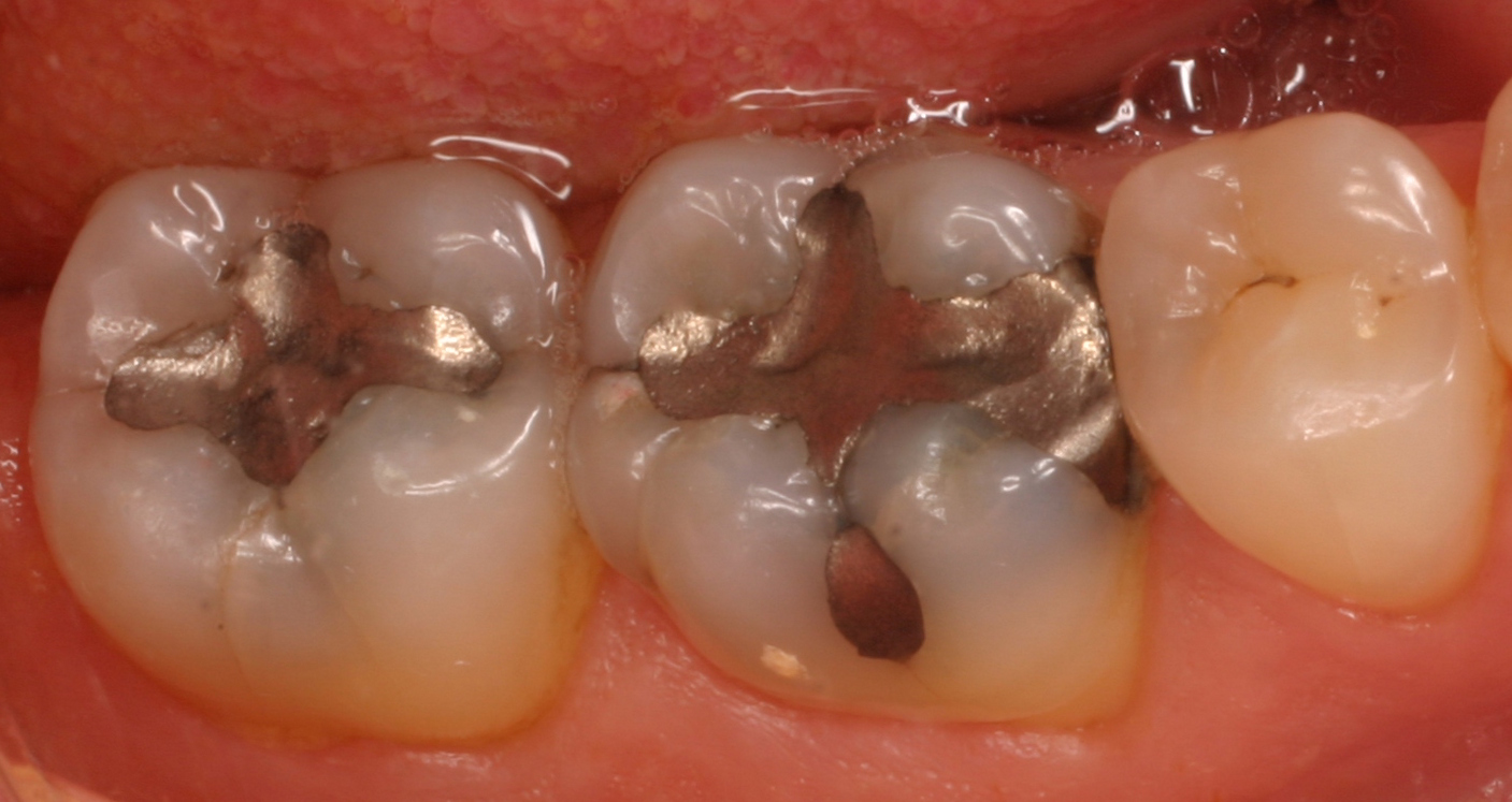 نیوزیلند استفاده از آمالگام در دندان کودکان را ممنوع کرد