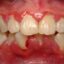 عدم رعایت بهداشت دهان، علت اصلی خون‌ریزی لثه