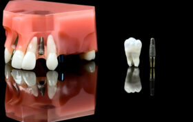 مسوولیت مدنی دندانپزشک نسبت به کیفیت انجام پروتز و ایمپلنت