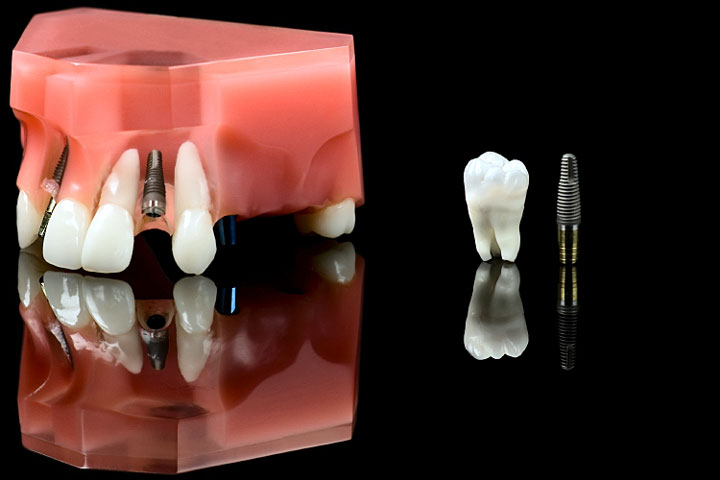مسوولیت مدنی دندانپزشک نسبت به کیفیت انجام پروتز و ایمپلنت