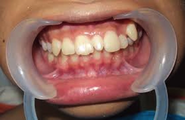 نقش دندان‌های اضافی در ناهنجاری‌های دهانی دندانی