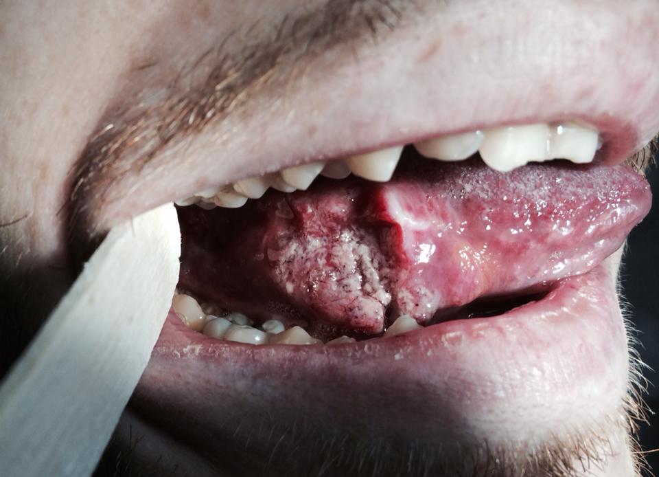 سرطان دهان، عوامل خطرساز و راه‌های تشخیص