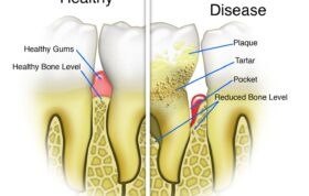 ارتباط بین بیماری‌های بافت نگه‌دارنده دندان و سلامت عمومی