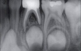 آیا دندان شیری عصب دارد؟