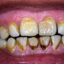 حساسیت دندان پس از جرم‌گیری طبیعی است
