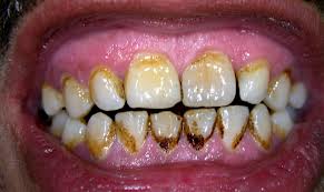 حساسیت دندان پس از جرم‌گیری طبیعی است