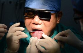 پزشک چینی زبانش را برای توقف خروپف زیر تیغ برد!