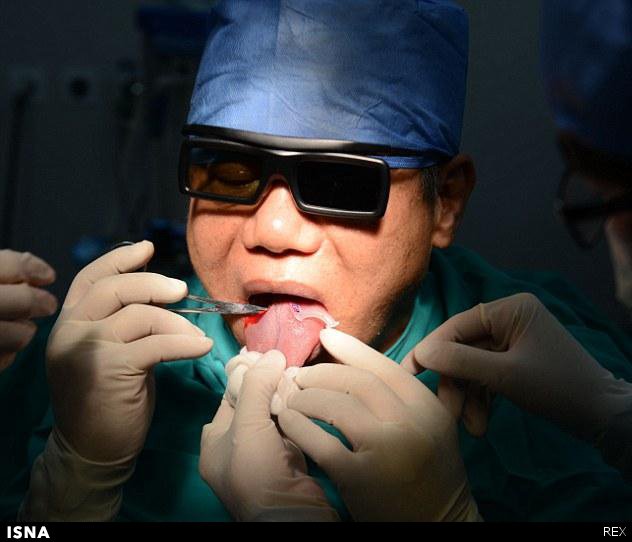 پزشک چینی زبانش را برای توقف خروپف زیر تیغ برد!