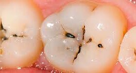 دندان‌ها چگونه دچار پوسیدگی می‌شوند؟