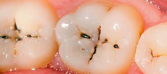 دندان‌ها چگونه دچار پوسیدگی می‌شوند؟
