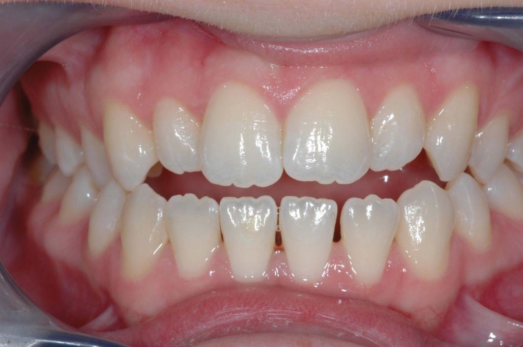 چرا برخی دندان‌ها دندانه‌دار هستند؟