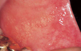 کوتاه درباره Fordyce granules