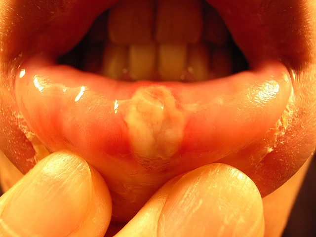 آفت دهانی چگونه درمان می‌شود؟