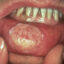 سرطان دهان ششمین سرطان شایع در انسان