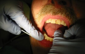 نقش بهداشت دهان در طول عمر ایمپلنت دندانی