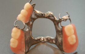 دندان‌هایی که دست دارند!/ درباره پروتزهای دندانی متحرک و روش‌های نگهداری از آن