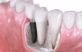 آیا ممکن است ایمپلنت‌های دندانی عفونت کنند؟