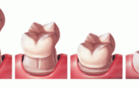 چه دندان‌هایی باید روکش شوند؟